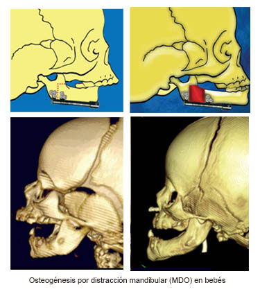 https://boxofbebe.store/SiteCollectionImages/Infant_Mandibular_Distraction_Osteogenesis_es.jpg