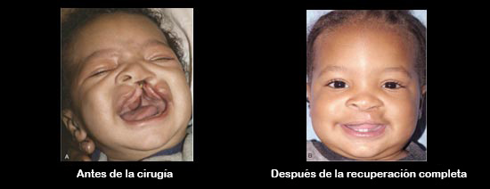 https://boxofbebe.store/SiteCollectionImagesArticleImages/CleftbeforeAfter_Baby_es.jpg