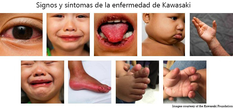 https://boxofbebe.store/SiteCollectionImagesArticleImages/Signs_Symptoms_Kawasaki_Disease_es.jpg