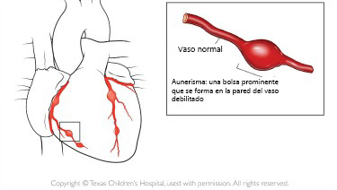 https://boxofbebe.store/SiteCollectionImagesArticleImages/aneurysm_texaschildrens_es.jpg